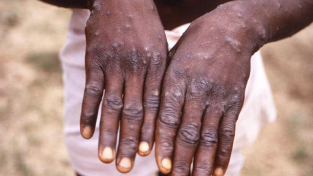 Medical Expert Tells Nigerians not to Panic over Monkeypox